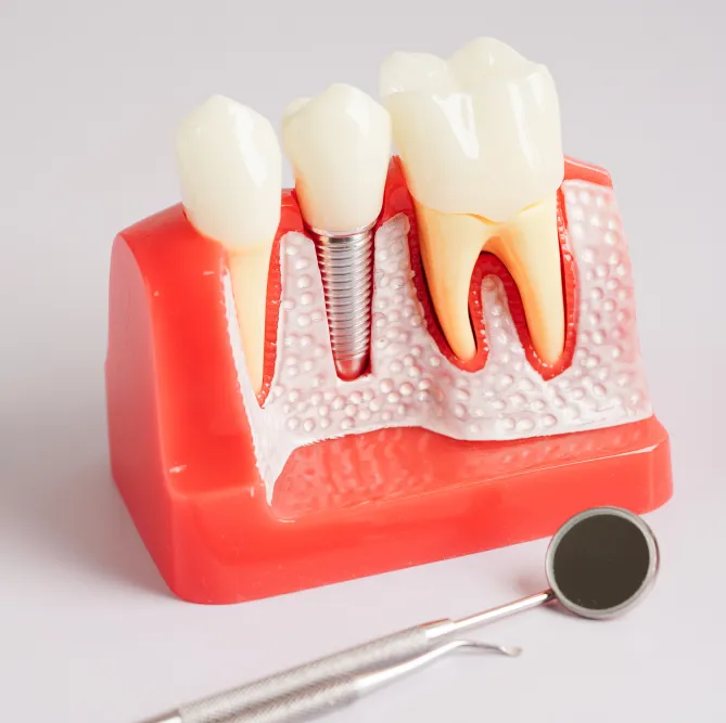 Dental Implants in Bloomington, MN